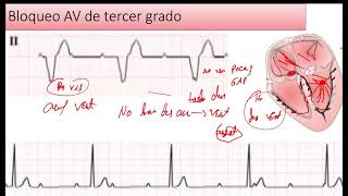 Bloqueo Auriculoventricular de Tercer Grado [upl. by Aciamaj]