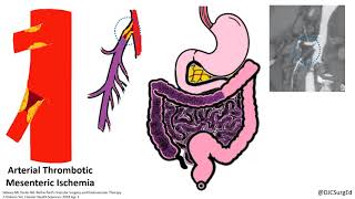 Acute Mesenteric Ischemia [upl. by Legin]