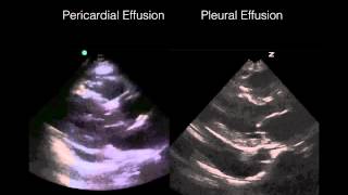 Cardiac Ultrasound Pericardial vs Pleural effusion [upl. by Annohsal]