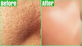 How To Get Rid Of LARGE PORES PERMANENTLY 100 Works Shrink amp Get Clear Glass Skin Naturally [upl. by Beitris]