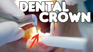 Dental Crown Procedure EXPLAINED [upl. by Cornelie]