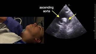 Suprasternal Echocardiography Scan Technique [upl. by Mure]