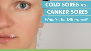 Cold Sores vs Canker Sores Whats The Difference [upl. by Ibib375]