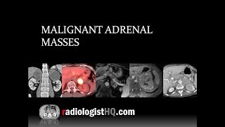 Malignant Adrenal Masses [upl. by Marv]