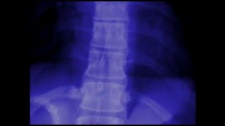 Areas of Inflammation in Ankylosing Spondylitis [upl. by Yrreb557]