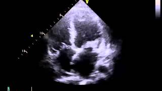 Echocardiography to Assess MitralValve Leaflets  NEJM [upl. by Flem]