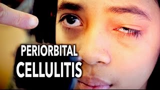 PERIORBITAL CELLULITIS Painful  Dr Paul [upl. by Ellennahc]