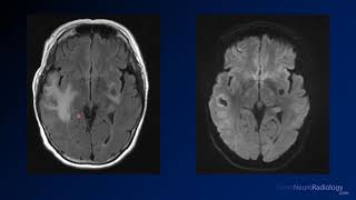 Imaging brain tumors  5  Non glial tumors [upl. by Katharina365]