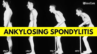 What is Ankylosing Spondylitis Causes Symptoms and Diagnosis EXPLAINED [upl. by Golanka]