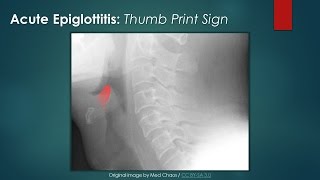 Acute Epiglottitis Thumb Sign [upl. by Endys]