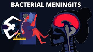 Acute Pyogenic Bacterial Meningitis Part 4 🩺 [upl. by Enitsenrae]