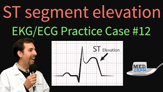 ST Elevation  EKG  ECG Interpretation Case 12 STEMI MI ACS [upl. by Tandi]