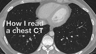 How I Read a Chest CT [upl. by Aiclef865]