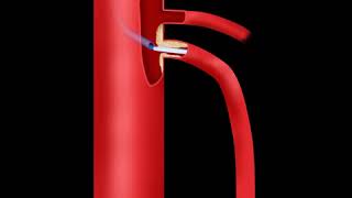 Superior Mesenteric Artery Stenting Animation [upl. by Latsirhc]