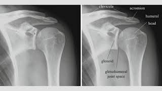 Shoulder Radiographic Evaluation [upl. by Rollin]