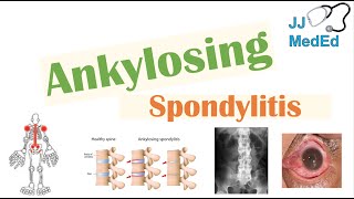 Ankylosing Spondylitis  HLAB27 Pathophysiology Signs amp Symptoms Diagnosis Treatment [upl. by Joel97]