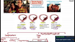 Webinar  Placenta Acrreta [upl. by Eihs]