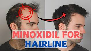 Minoxidil for Frontal Baldness  Restore Your Hairline [upl. by Mcclain]