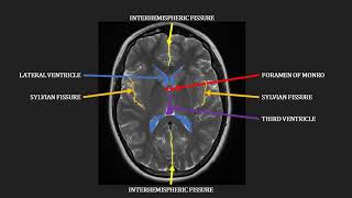 Introduction to MRI of the brain [upl. by Alset841]