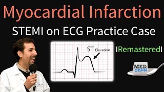 Myocardial Infarction  STEMI on ECG  Practice EKG [upl. by Siladnerb98]