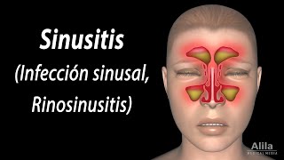 Sinusitis Animación Alila Medical Media Español [upl. by Rothberg253]