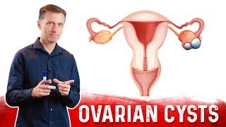 Ovarian Cysts Causes Symptoms amp Natural Treatment – DrBerg [upl. by Hinckley]