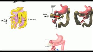 Gut Malrotation Nonrotation and Volvulus for USMLE [upl. by Derdle726]