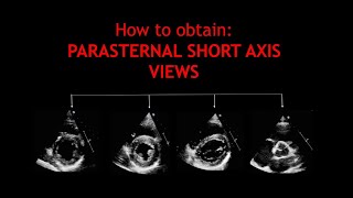 How to obtain PARASTERNAL SHORT AXIS VIEWS [upl. by Rhiana]