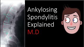 Ankylosing Spondylitis Explained [upl. by Alexia]