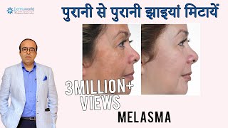 पुरानी से पुरानी झाइयां हटाए  Melasma  causes  precautions and treatment  Dark Spots [upl. by Alehcim588]