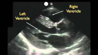 Cardiac Ultrasound  Parasternal Long Axis  Part 1  Sonosite Inc [upl. by Esinned]