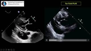 Transthoracic Echocardiography Parasternal Views [upl. by Sophia]