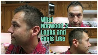 What Norwood 3 Looks and Feels Like Receding HairlineBalding [upl. by Aititel149]