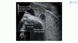 MDCAST Placenta Accreta Spectrum Disorder [upl. by Darsie207]