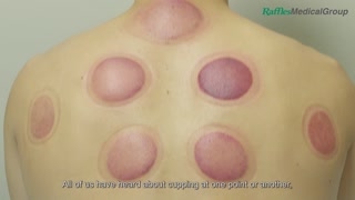 What You Need to Know about Cupping [upl. by Nerag]