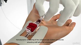 MEDBAR  Arterial Cannula [upl. by Ginnifer295]