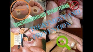 Trichomoniasis symptomsTreatment and Prevention [upl. by Arytahs]