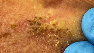 Extremely Clogged Pores Extracted  Contour Dermatology [upl. by Mccallion401]