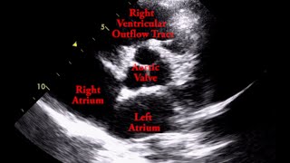 Aortic Valve  Parasternal Short Axis [upl. by Eniaral]