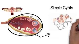 OVARIAN CYSTSwhat you need to know [upl. by Hermina]