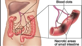 Mesenteric Ischemia [upl. by Ahseikan]