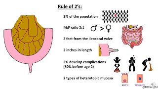 Meckel’s Diverticulum [upl. by Aisatnaf868]