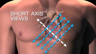 Parasternal Short Axis Views [upl. by Erastatus]