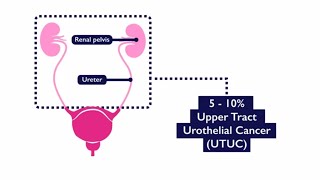 Understanding Squamous Cell Carcinoma [upl. by Juliann]