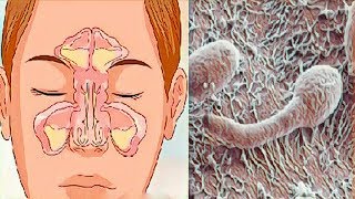 ¿Nariz obstruida rinitis o sinusitis Sepa cómo resolver [upl. by Justicz]