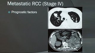 Renal Cell Carcinoma [upl. by Shirleen310]