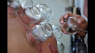 Cupping Pain Therapy [upl. by Baoj]