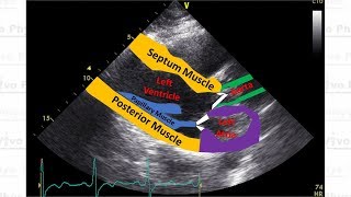 Hypertrophic Cardiomyopathy Parasternal Long Axis Echocardiogram View [upl. by Keever]