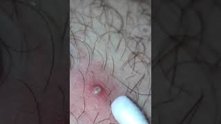 INGROWN HAIR FOLLICLE [upl. by Brechtel]