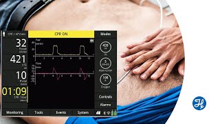 Feature spotlight  CPR ventilation for HAMILTONC1T1MR1 [upl. by Brenza]